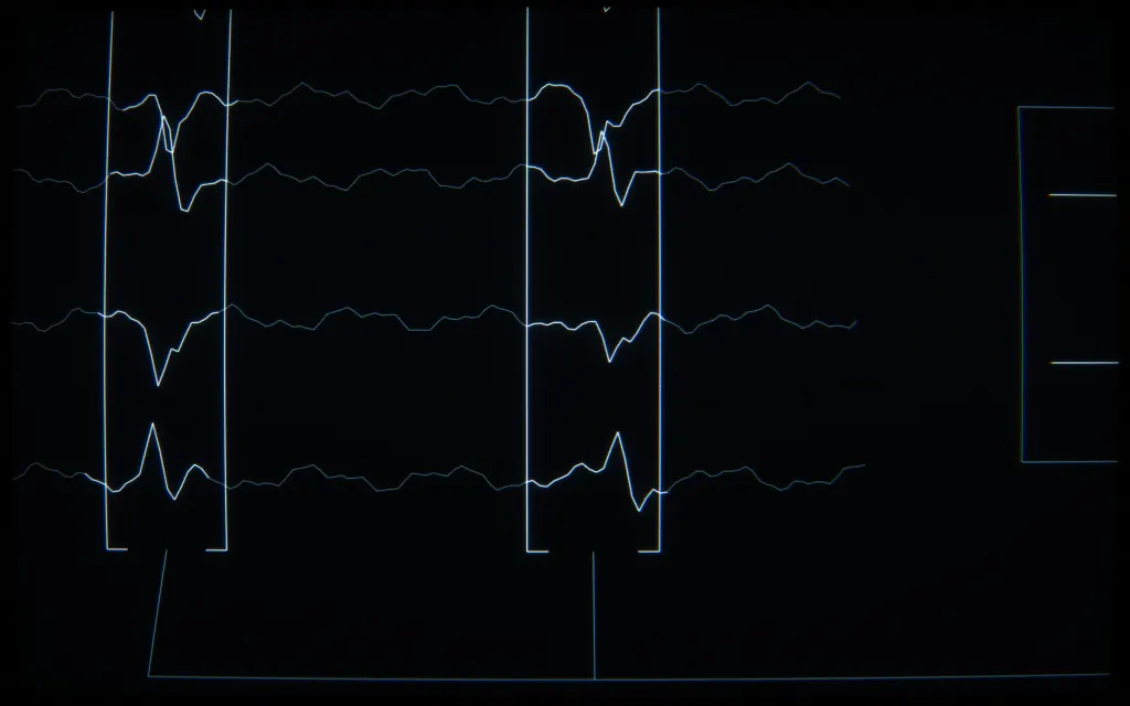 CRT line drawing: stacked EEG traces with two bracketed spike windows, close up